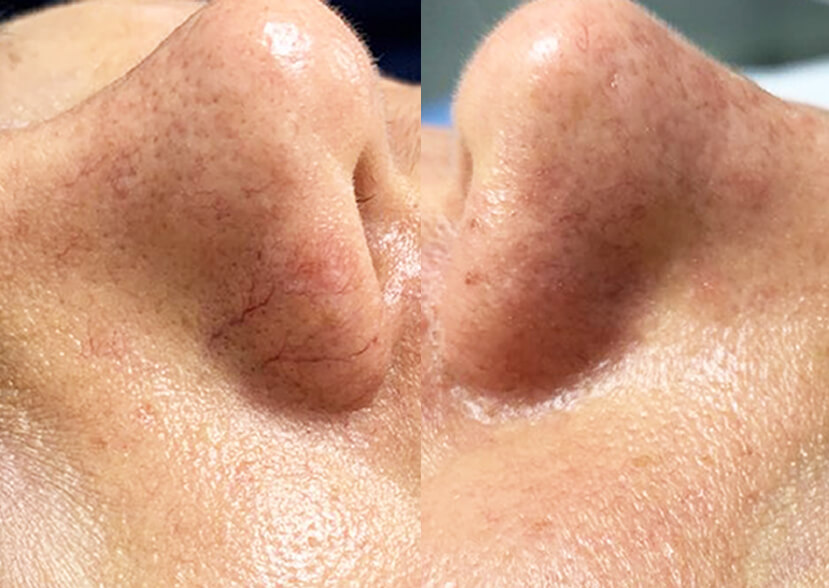 Tratamiento facial con láser Q-Switch y Hollywood Peel